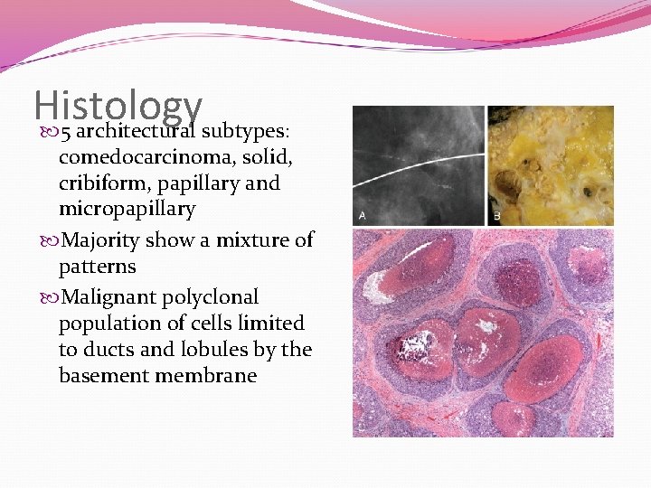 Histology 5 architectural subtypes: comedocarcinoma, solid, cribiform, papillary and micropapillary Majority show a mixture