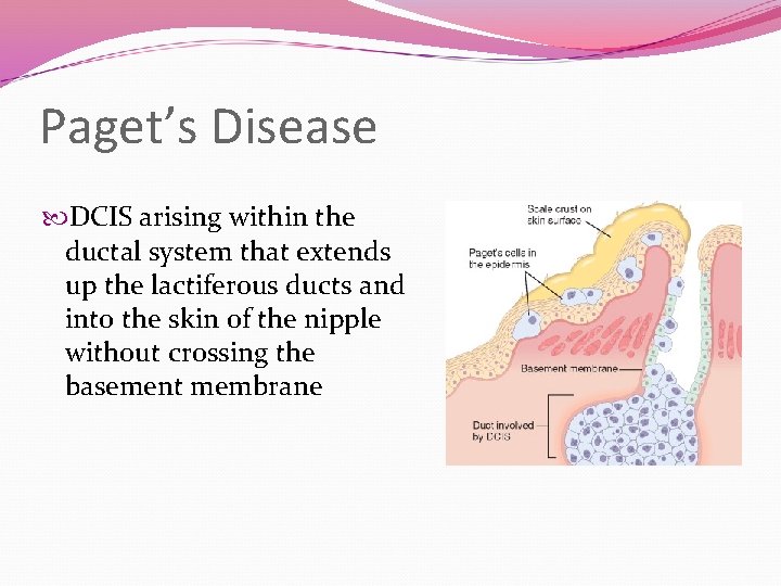 Paget’s Disease DCIS arising within the ductal system that extends up the lactiferous ducts