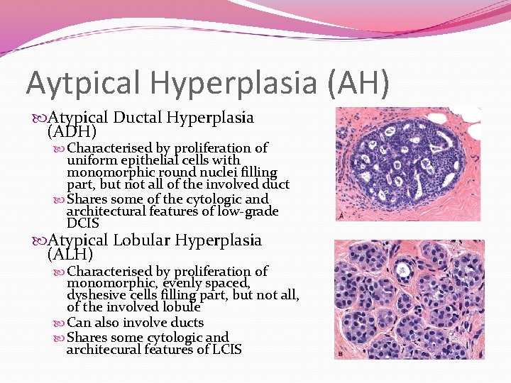 Aytpical Hyperplasia (AH) Atypical Ductal Hyperplasia (ADH) Characterised by proliferation of uniform epithelial cells