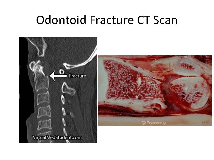 Odontoid Fracture CT Scan 