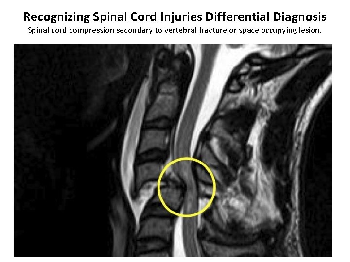 Recognizing Spinal Cord Injuries Differential Diagnosis Spinal cord compression secondary to vertebral fracture or