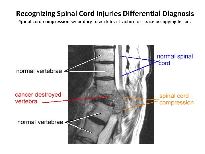 Recognizing Spinal Cord Injuries Differential Diagnosis Spinal cord compression secondary to vertebral fracture or