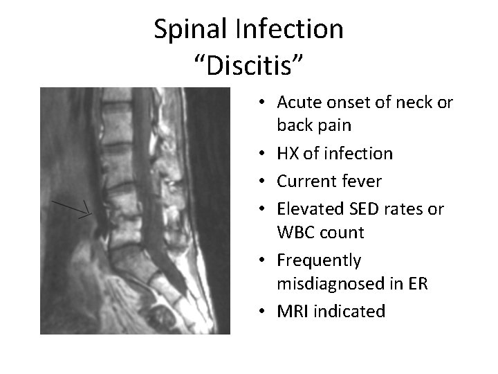Spinal Infection “Discitis” • Acute onset of neck or back pain • HX of