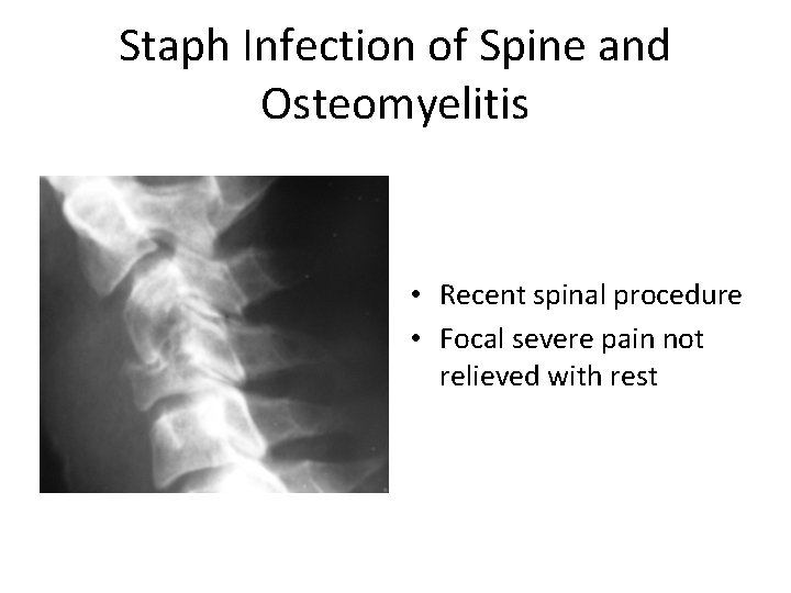 Staph Infection of Spine and Osteomyelitis • Recent spinal procedure • Focal severe pain