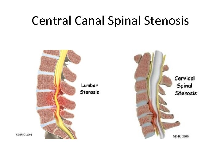 Central Canal Spinal Stenosis 