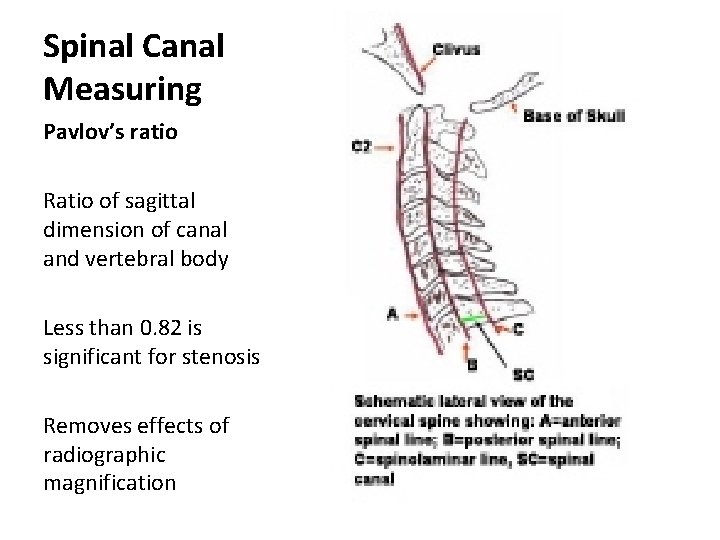 Spinal Canal Measuring Pavlov’s ratio Ratio of sagittal dimension of canal and vertebral body