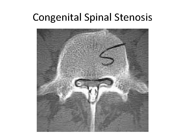 Congenital Spinal Stenosis 