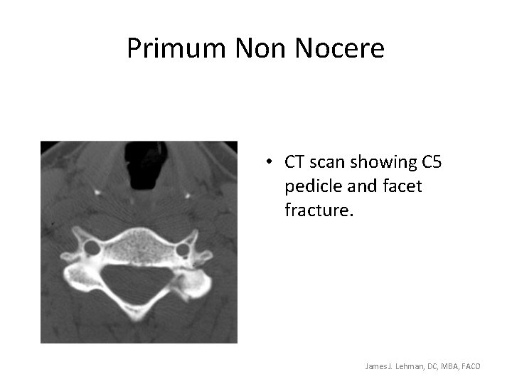 Primum Non Nocere • CT scan showing C 5 pedicle and facet fracture. James