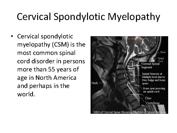 Cervical Spondylotic Myelopathy • Cervical spondylotic myelopathy (CSM) is the most common spinal cord