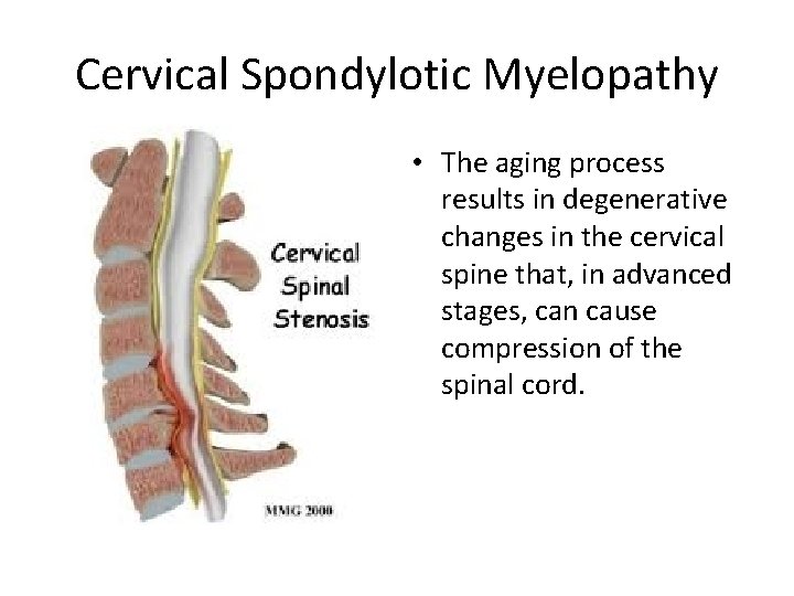 Cervical Spondylotic Myelopathy • The aging process results in degenerative changes in the cervical