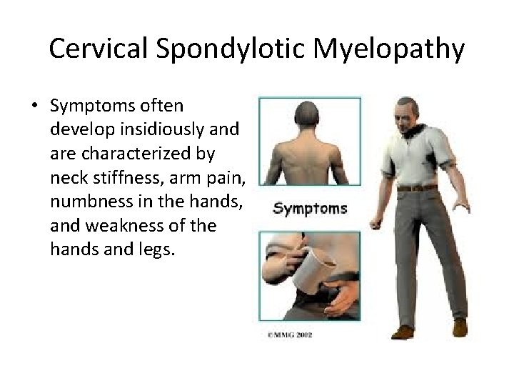 Cervical Spondylotic Myelopathy • Symptoms often develop insidiously and are characterized by neck stiffness,