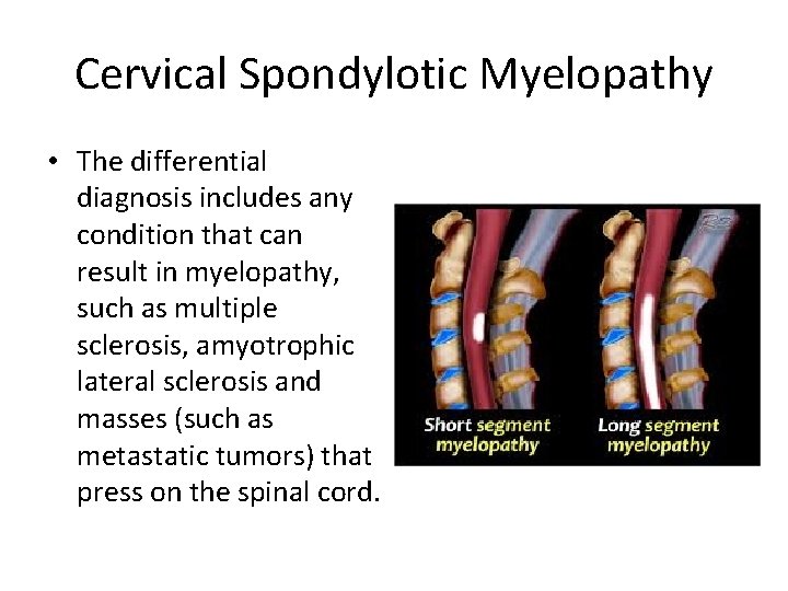 Cervical Spondylotic Myelopathy • The differential diagnosis includes any condition that can result in