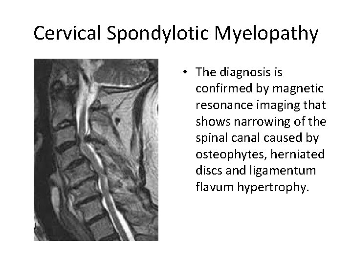 Cervical Spondylotic Myelopathy • The diagnosis is confirmed by magnetic resonance imaging that shows