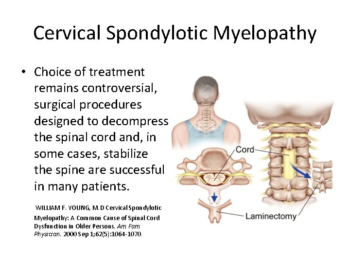 Cervical Spondylotic Myelopathy • Choice of treatment remains controversial, surgical procedures designed to decompress