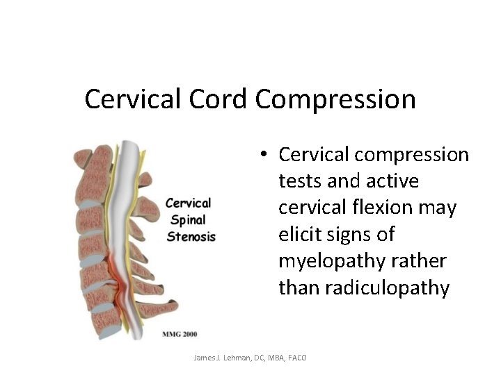 Cervical Cord Compression • Cervical compression tests and active cervical flexion may elicit signs