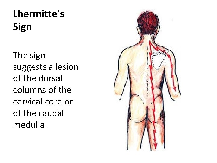 Lhermitte’s Sign The sign suggests a lesion of the dorsal columns of the cervical