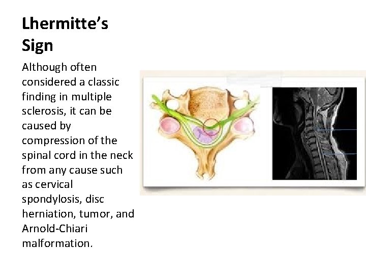 Lhermitte’s Sign Although often considered a classic finding in multiple sclerosis, it can be