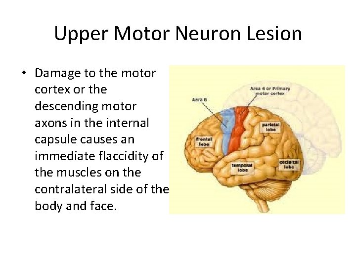 Upper Motor Neuron Lesion • Damage to the motor cortex or the descending motor