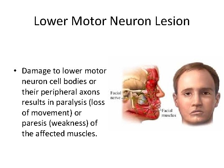 Lower Motor Neuron Lesion • Damage to lower motor neuron cell bodies or their