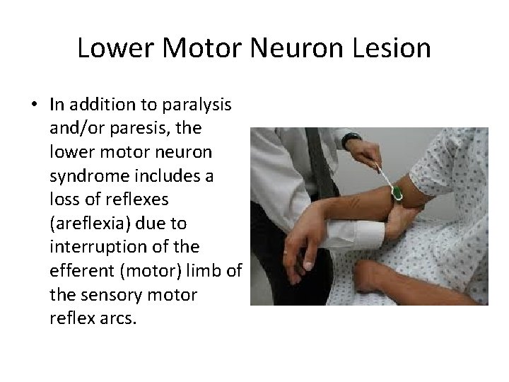 Lower Motor Neuron Lesion • In addition to paralysis and/or paresis, the lower motor