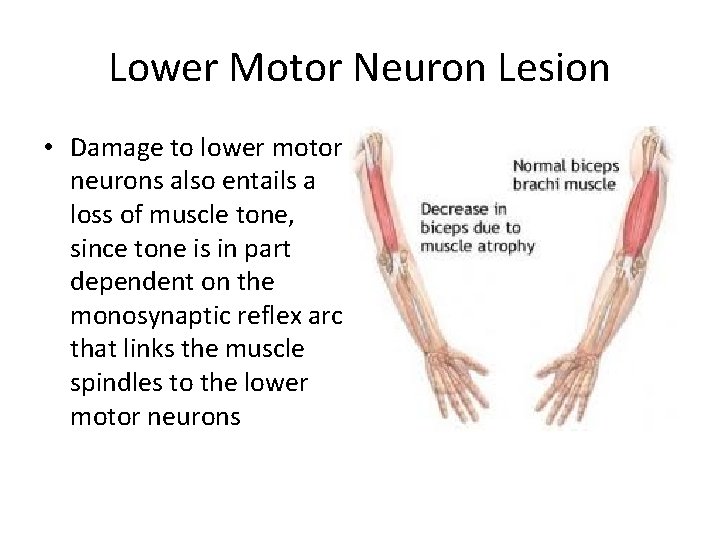 Lower Motor Neuron Lesion • Damage to lower motor neurons also entails a loss