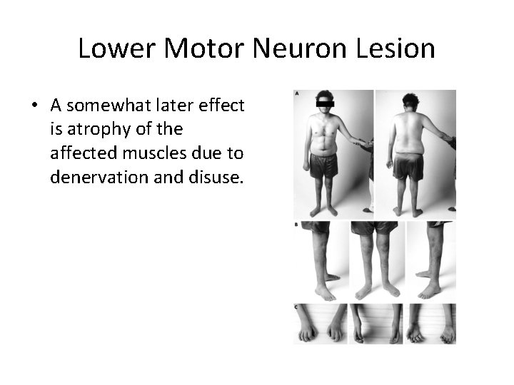 Lower Motor Neuron Lesion • A somewhat later effect is atrophy of the affected