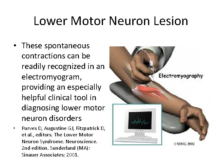 Lower Motor Neuron Lesion • These spontaneous contractions can be readily recognized in an