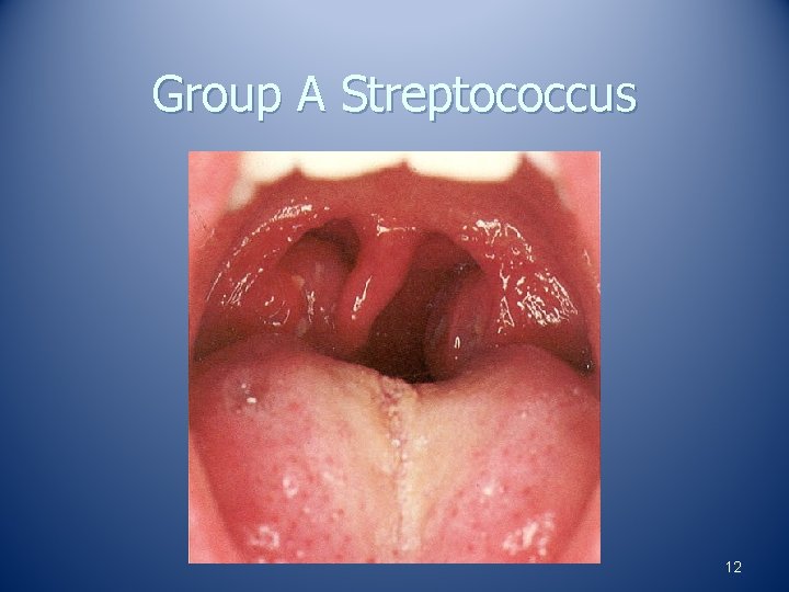 Group A Streptococcus 12 