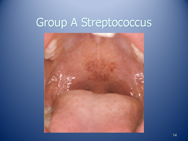 Group A Streptococcus 14 