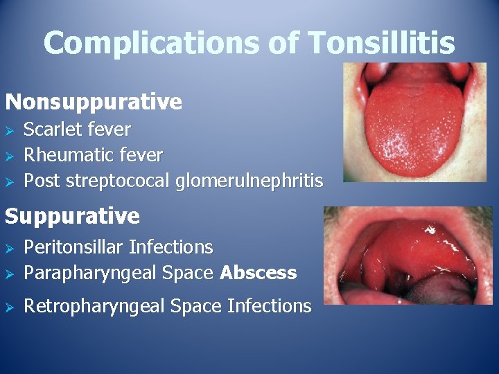 Complications of Tonsillitis Nonsuppurative Ø Ø Ø Scarlet fever Rheumatic fever Post streptococal glomerulnephritis