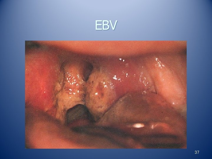 EBV 37 