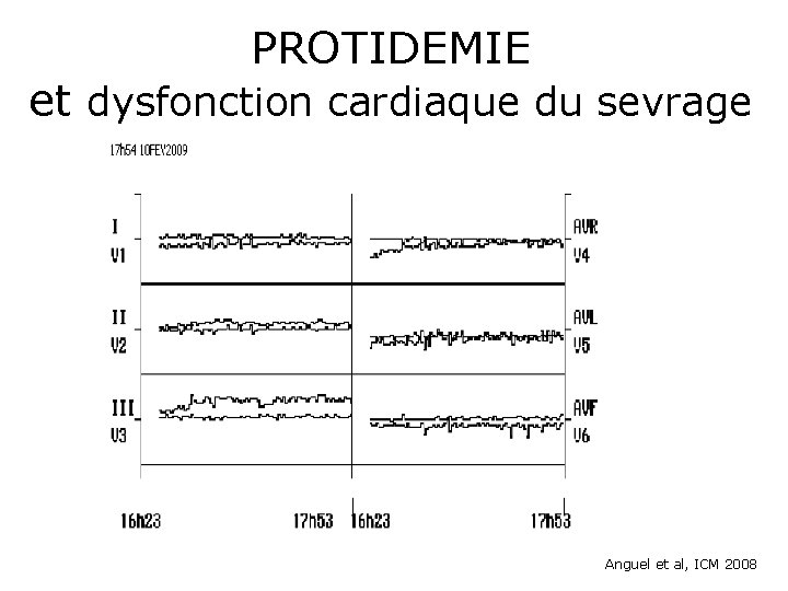 PROTIDEMIE et dysfonction cardiaque du sevrage Anguel et al, ICM 2008 