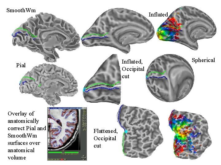 Smooth. Wm Inflated, Occipital cut Pial Overlay of anatomically correct Pial and Smooth. Wm