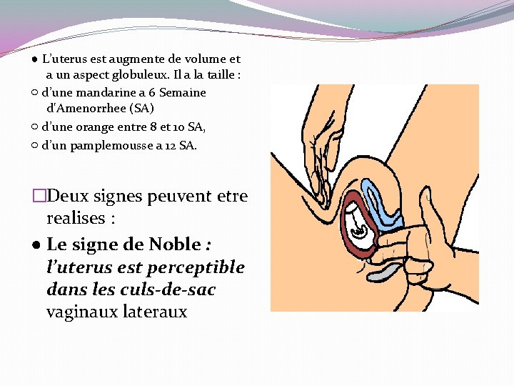 ● L’uterus est augmente de volume et a un aspect globuleux. Il a la