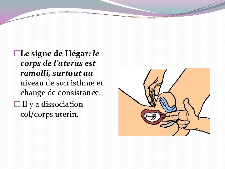 �Le signe de Hégar: le corps de l’uterus est ramolli, surtout au niveau de