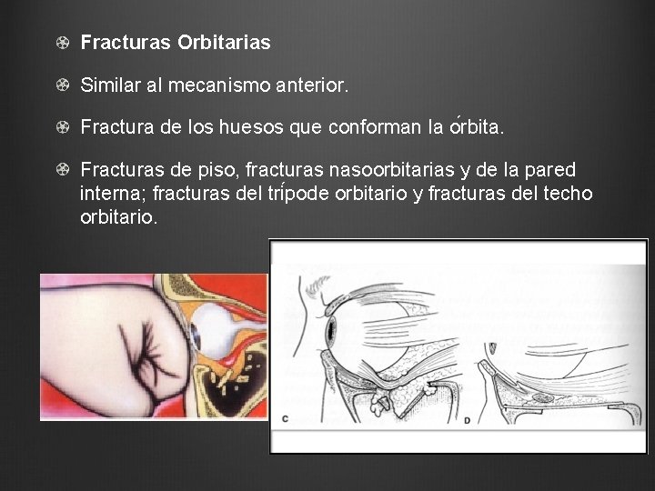 Fracturas Orbitarias Similar al mecanismo anterior. Fractura de los huesos que conforman la o