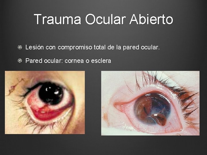 Trauma Ocular Abierto Lesión compromiso total de la pared ocular. Pared ocular: cornea o