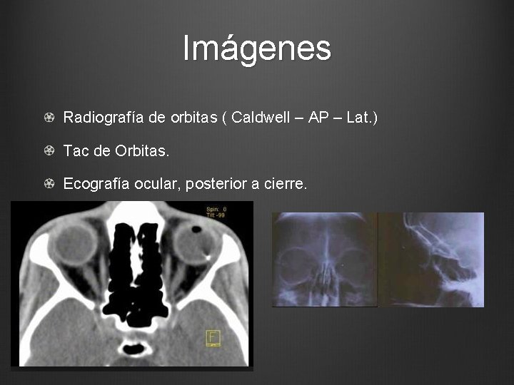 Imágenes Radiografía de orbitas ( Caldwell – AP – Lat. ) Tac de Orbitas.