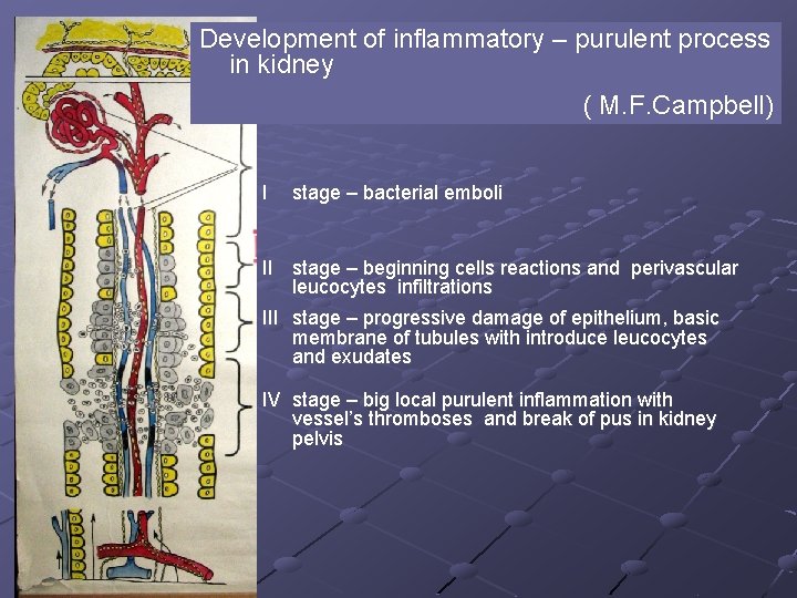 Development of inflammatory – purulent process in kidney ( M. F. Campbell) I stage