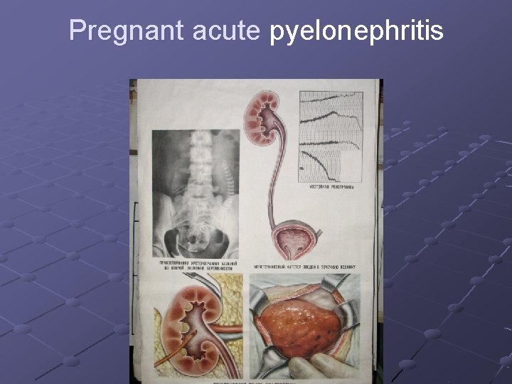 Pregnant acute pyelonephritis 