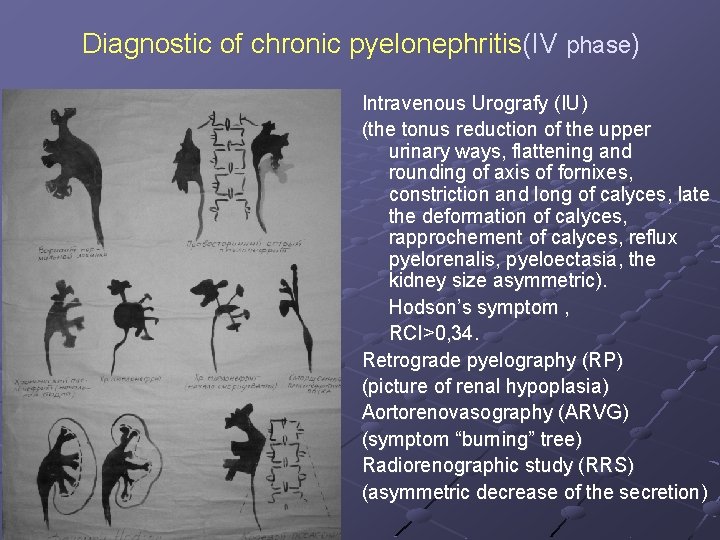 Diagnostic of chronic pyelonephritis(IV phase) Intravenous Urografy (IU) (the tonus reduction of the upper
