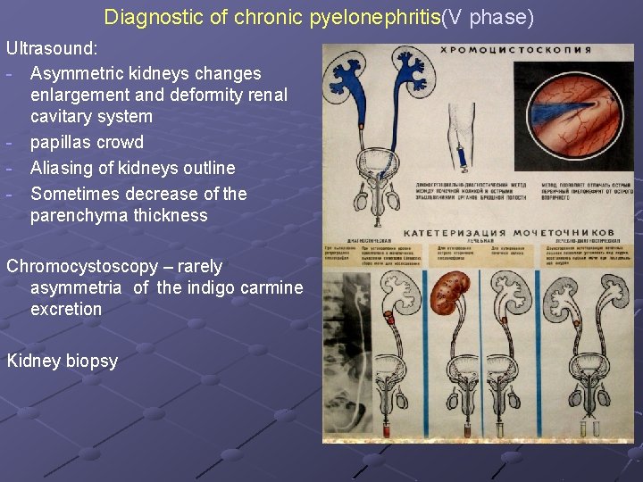 Diagnostic of chronic pyelonephritis(V phase) Ultrasound: - Asymmetric kidneys changes enlargement and deformity renal