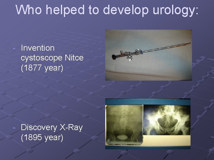 Who helped to develop urology: - Invention cystoscope Nitce (1877 year) - Discovery X-Ray