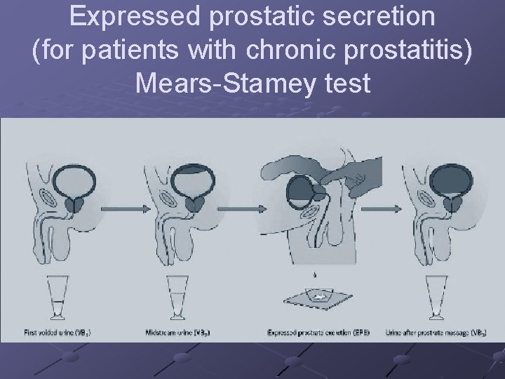 Expressed prostatic secretion (for patients with chronic prostatitis) Mears-Stamey test 