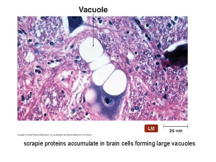 [INSERT FIGURE 13. 23] scrapie proteins accumulate in brain cells forming large vacuoles 