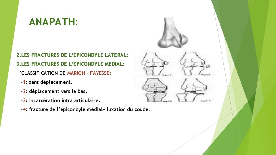 ANAPATH: 2. LES FRACTURES DE L’EPICONDYLE LATERAL: 3. LES FRACTURES DE L’EPICONDYLE MEDIAL: *CLASSIFICATION