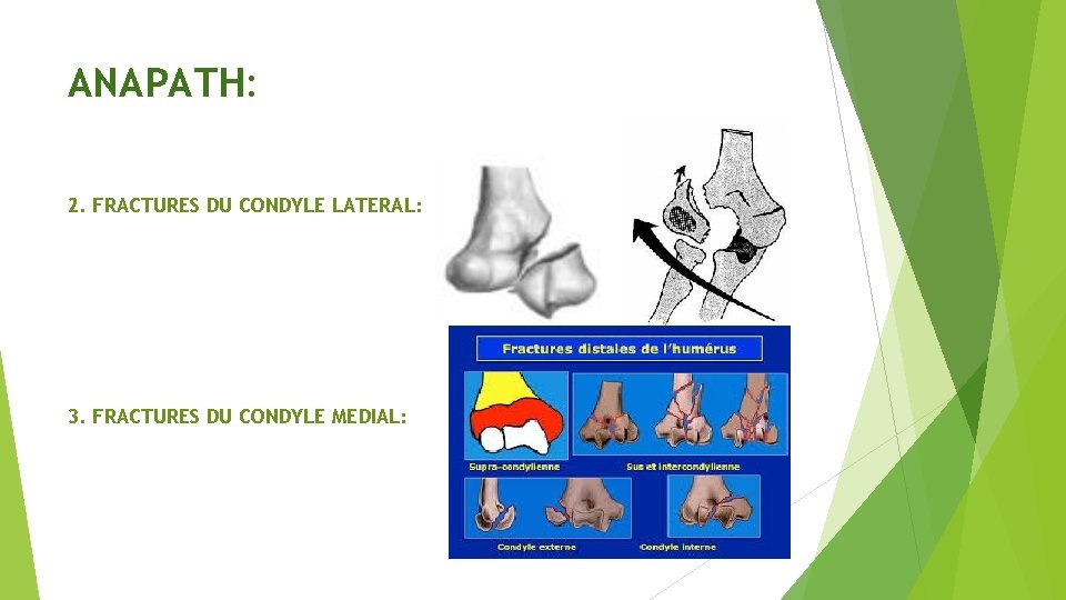 ANAPATH: 2. FRACTURES DU CONDYLE LATERAL: 3. FRACTURES DU CONDYLE MEDIAL: 