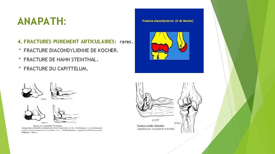 ANAPATH: 4. FRACTURES PUREMENT ARTICULAIRES: rares. * FRACTURE DIACONDYLIENNE DE KOCHER. * FRACTURE DE