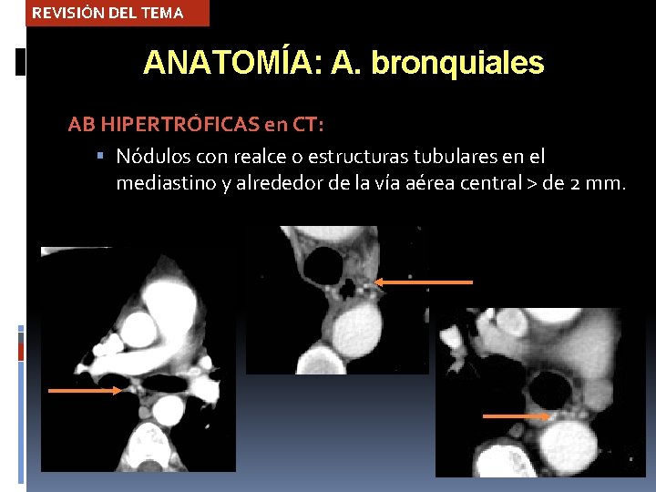 REVISIÓN DEL TEMA ANATOMÍA: A. bronquiales AB HIPERTRÓFICAS en CT: Nódulos con realce o
