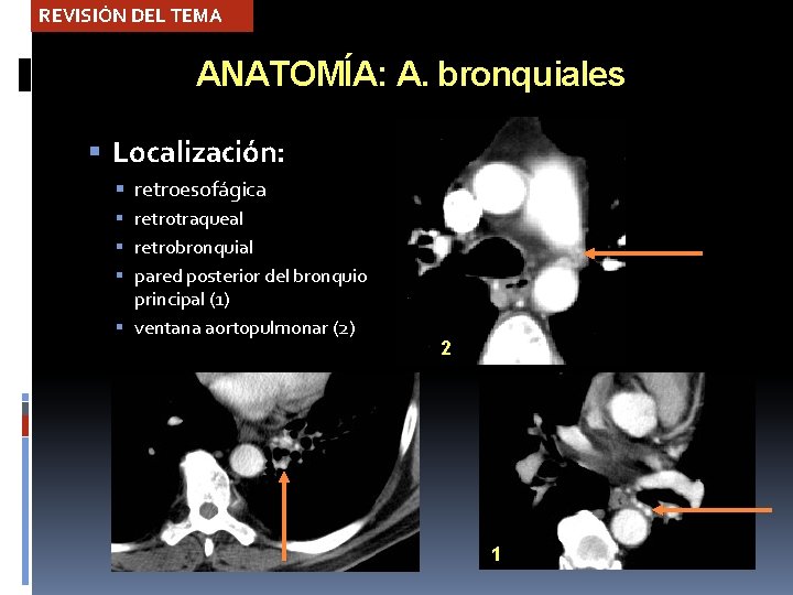 REVISIÓN DEL TEMA ANATOMÍA: A. bronquiales Localización: retroesofágica retrotraqueal retrobronquial pared posterior del bronquio